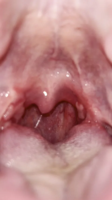 Post-Tonsillectomy Day 23 — Residual Tissue, Former Tonsillar Attachment Sites Stock Footage 336393736