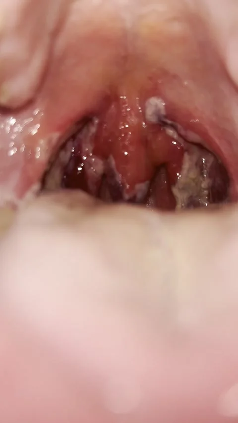 Post-Tonsillectomy Day 3 — Secondary Hemorrhage Event Stock Footage 336393731