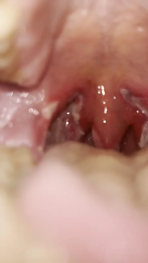 Post-Tonsillectomy Day 5 — Early Eschar Development Stock Footage 336393620