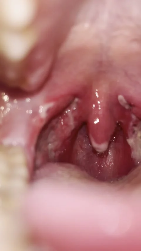 Post-Tonsillectomy Day 7 — First Clinical Follow-Up, Bilateral Healing Stock Footage 336393754