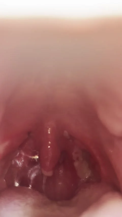 Post-Tonsillectomy Day 8 — Unilateral Scar Tissue Visible, Tonsillar Fossa Stock Footage 336393628