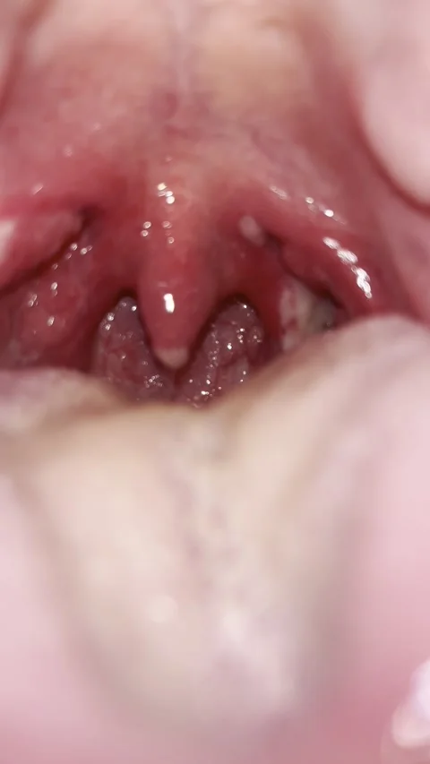 Post-Tonsillectomy Day 9 — Bilateral Scar Progression Stock Footage 336393658