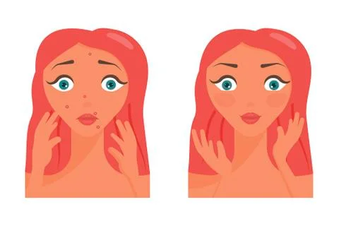 Poster of acne pimples. Illustrazione stock