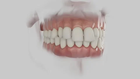 Posterior Cross Bite 動画素材 317092399