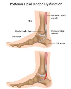 Posterior tibial tendon problems Stock Illustration