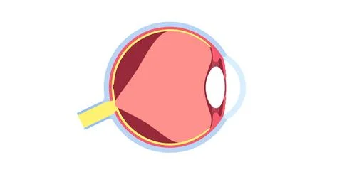 Posterior vitreous detachment Stock Illustration