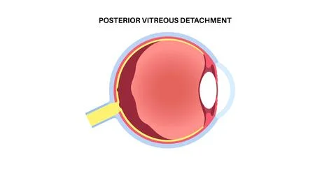 Posterior vitreous detachment Stock Illustration