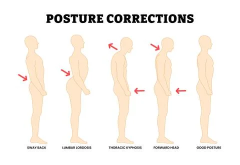 Posture Correction. Spinal Deformities, Incorrect Alignment. Educational Me.. Stock Illustration