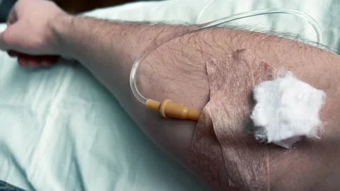 POV of a man's arm with an IV needle in the median cubital vein. Medical care Stock Footage 259852504