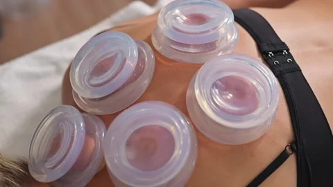 A practitioner applies suction cups on the back of a female client to engage in Vídeo Stock 344379293