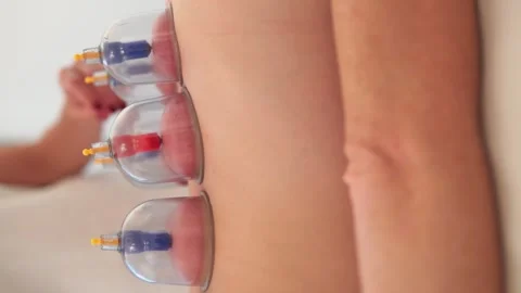 Practitioner performing vacuum cupping therapy on the back of a woman Stock Footage 255129263