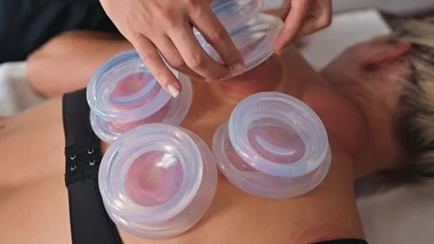 A practitioner performs cupping therapy on a person's back using suction cups to Vídeos de archivo 344379446
