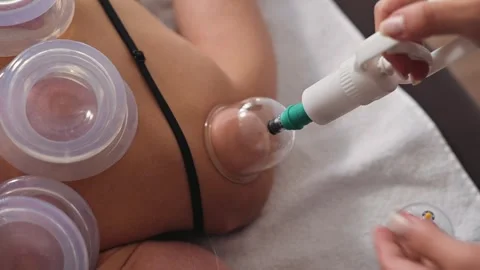 A practitioner uses suction cups on a client to perform cupping therapy in a Видео 344379346