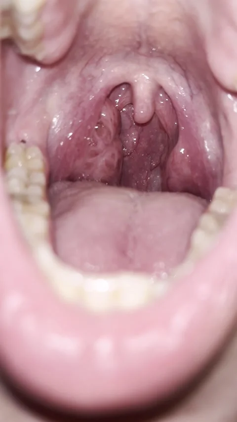 Pre-Operative Tonsil Assessment — Bilateral Tonsillar Hypertrophy, Day -3 Stock Footage 336393749