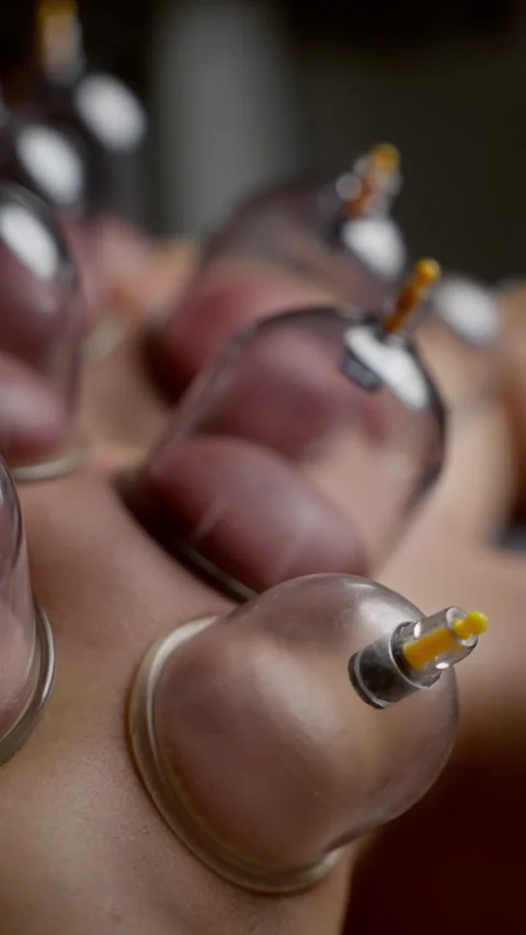 Precise cupping therapy technique showing translucent glass cups adhering to Stock Footage 300361354