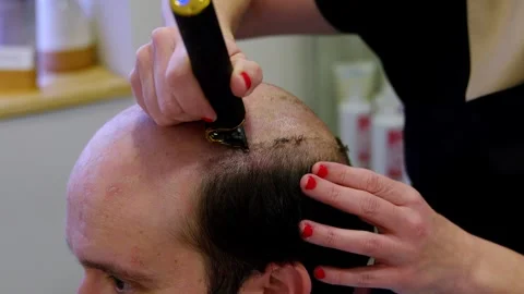 Precise Hair Trimming for Prosthesis Integration at Hair Clinic Stock Footage 272212503