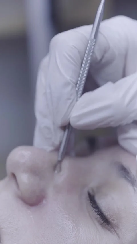 Precise metal tool gliding along closed eye during facial treatment Vídeo Stock 342820862