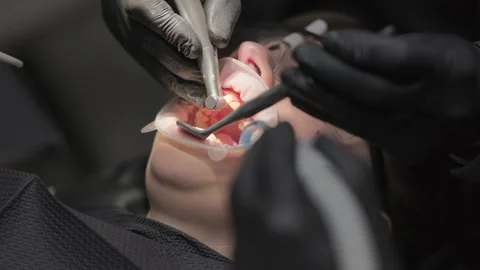 Precise tooth reduction for crown placement performed by dentist using rotary Stock Footage 339274255