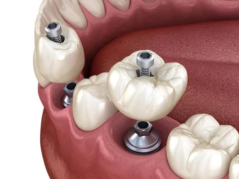 Premolar and Molar tooth crown installation over implant, screw fixation. Stock Illustration