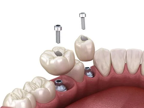 Premolar and Molar tooth crown installation over implant, screw fixation. Stock Illustration