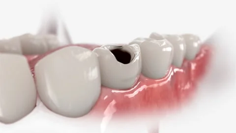 Premolar crown 動画素材 139195046