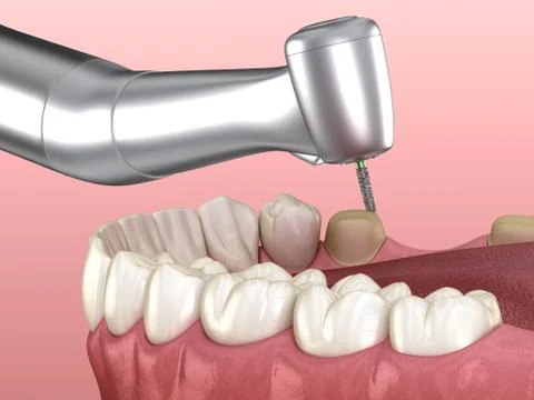 Premolar preparation process for dental crown placement. Medically accurate 3 Stock Illustration