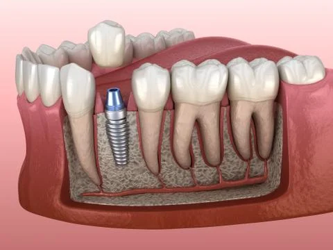Premolar tooth crown installation over implant abutment. Medically accurate 3 Stock Illustration