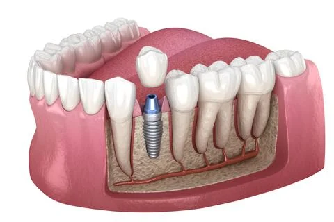 Premolar tooth crown installation over implant abutment. Stock Illustration