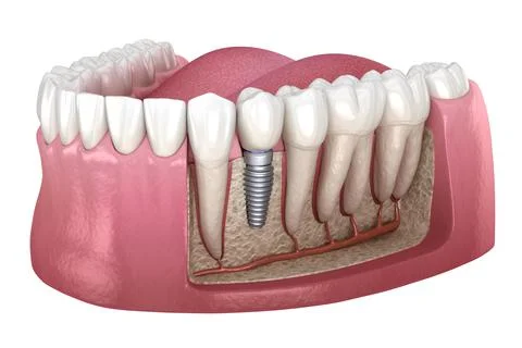 Premolar tooth crown installation over implant abutment. Stock Illustration