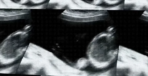 Prenatal diagnostic echography displaying first trimester fetal development.. Stock Footage 320387771