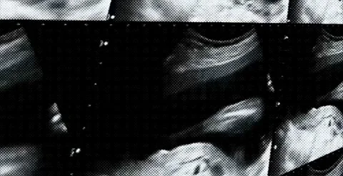 Prenatal diagnostic echography displaying first trimester fetal development.. Stock Footage 320387774
