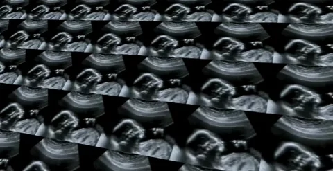 Prenatal diagnostic echography displaying first trimester fetal development.. Stock Footage 320387884