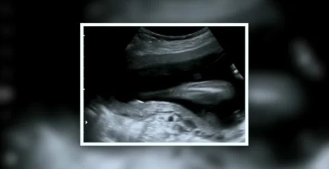 Prenatal diagnostic echography displaying first trimester fetal development.. Stock Footage 320388017