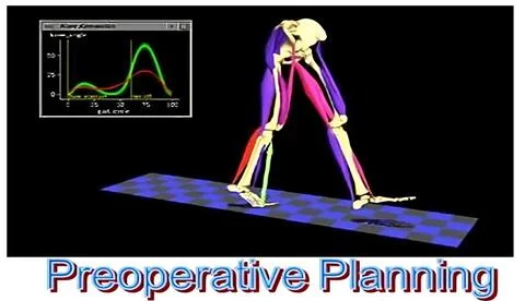 Preoperative Planning for Surgical Procedures Using Motion Analysis and Bio.. Stock Photos