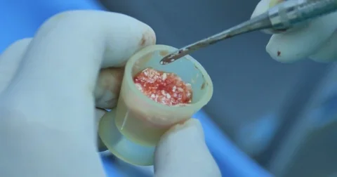Preparation biomaterials for bone regeneration Stock Footage 70172691
