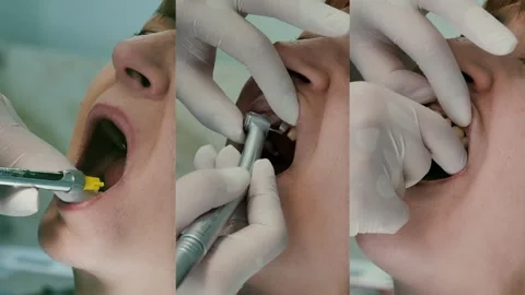 Preparation of teeth for prosthetics. the use of anesthesia in dentistry Stock Footage 246947744