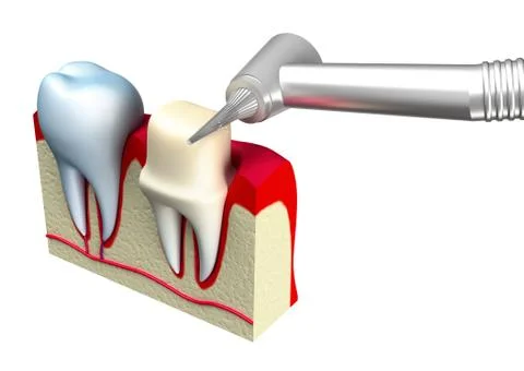 Preparation of the tooth crown for prosthetics Illustrazione stock