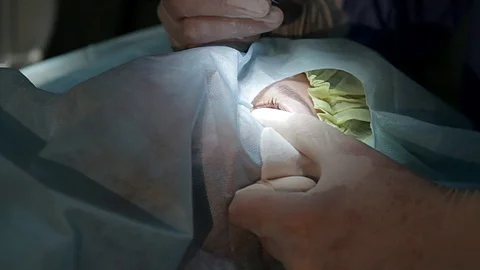 Preparations for the operation of laser vision correction Video stock 100123569