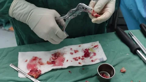 Preparing bone graft for spine procedure in the operating room Stock Footage 151460844