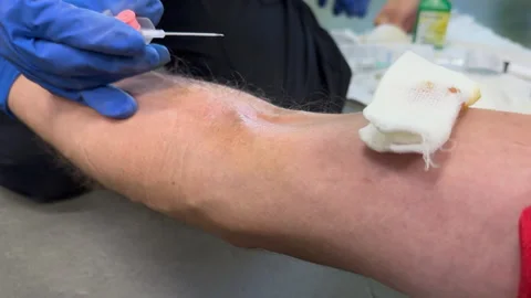 Preparing hand of wounded person for placing cannula during training and studyin Stock Footage 252011728