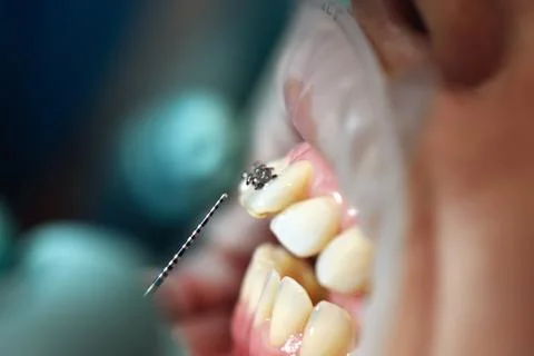Preparing To Install Braces On Tteeth Stock Photos