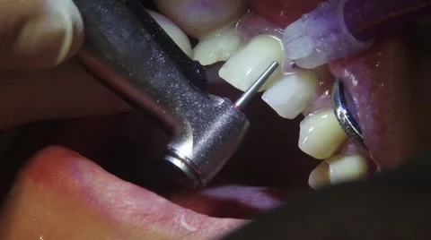 Preparing teeth for dental veneers Video stock 61156382