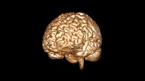 Presentation Of A Whole Brain Ax T2 FLAIR 3D-VR Stock Footage 125126292