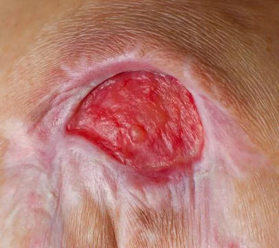 Pressure Ulcer on the Lower Back, Close-Up Medical Image 스톡 사진