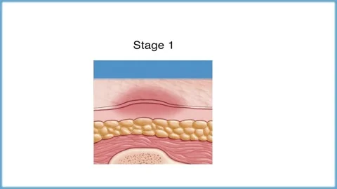 Pressure Ulcers, Bedsore,  Common Locations Stock Footage 194823112