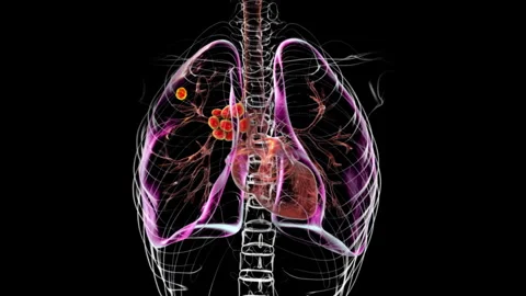 Primary lung tuberculosis, animation Stock Footage 295178674