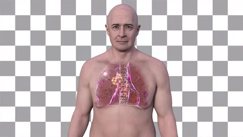 Primary lung tuberculosis causing Ranke complex, animation Stock Footage 278400033