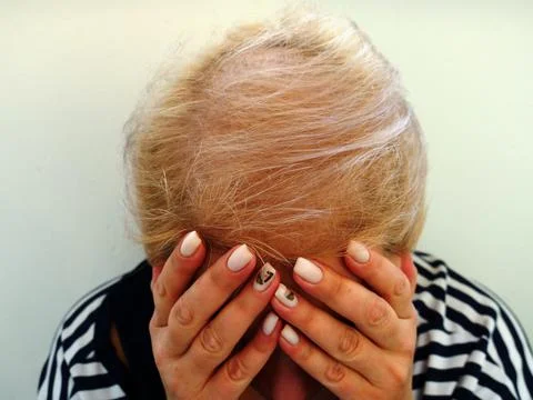 The problem of female pattern baldness Stock Photos