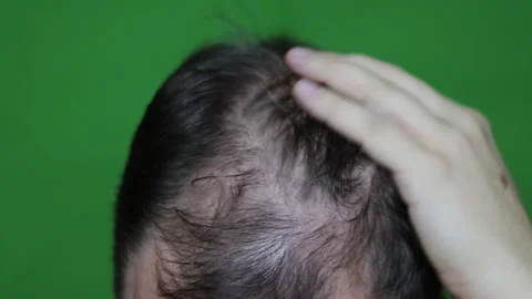 Problem of hair loss in men after forty. Male Pattern Baldness Video stock 148187961