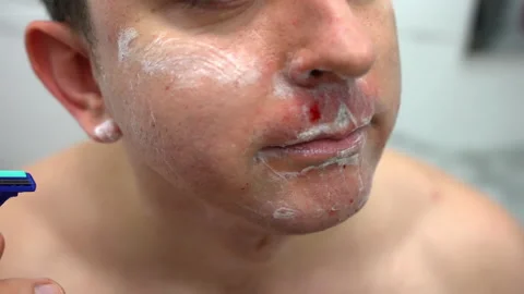Problem of heavy irritation, redness and blood on face after shaving with razor Stock-Footage 220261694